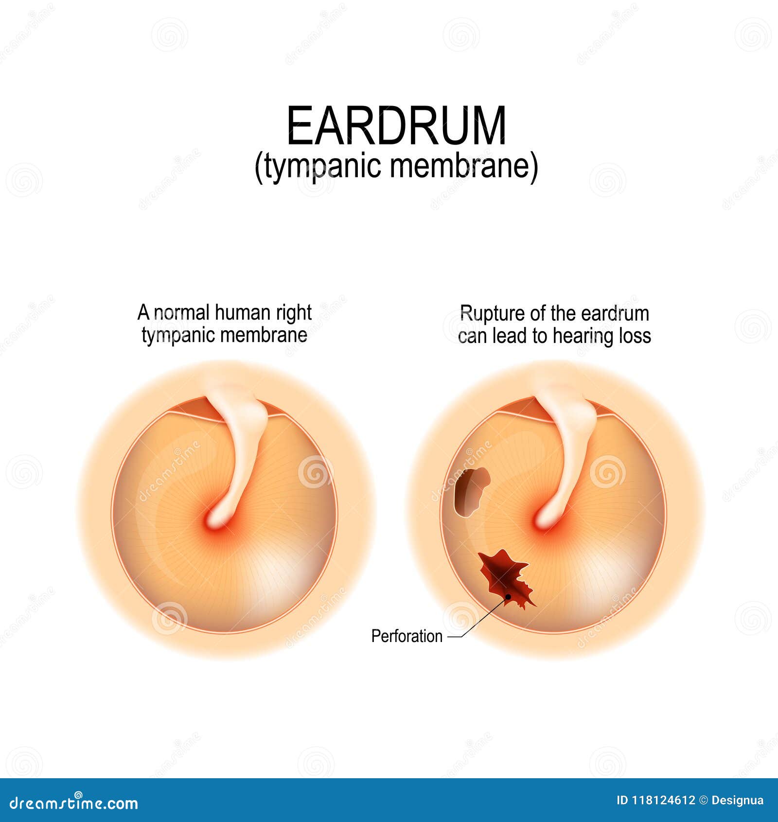 ruptured perforated eardrum