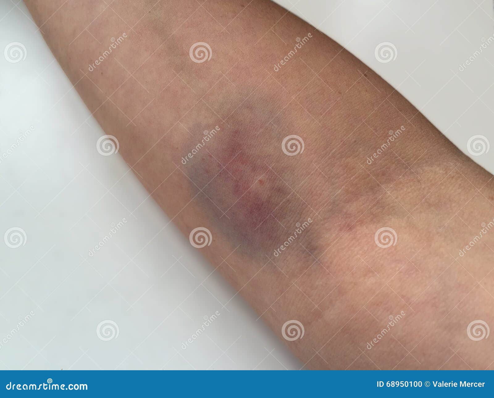 vein-hematoma-on-female-hand-after-phlebotomy-royalty-free-stock-photo