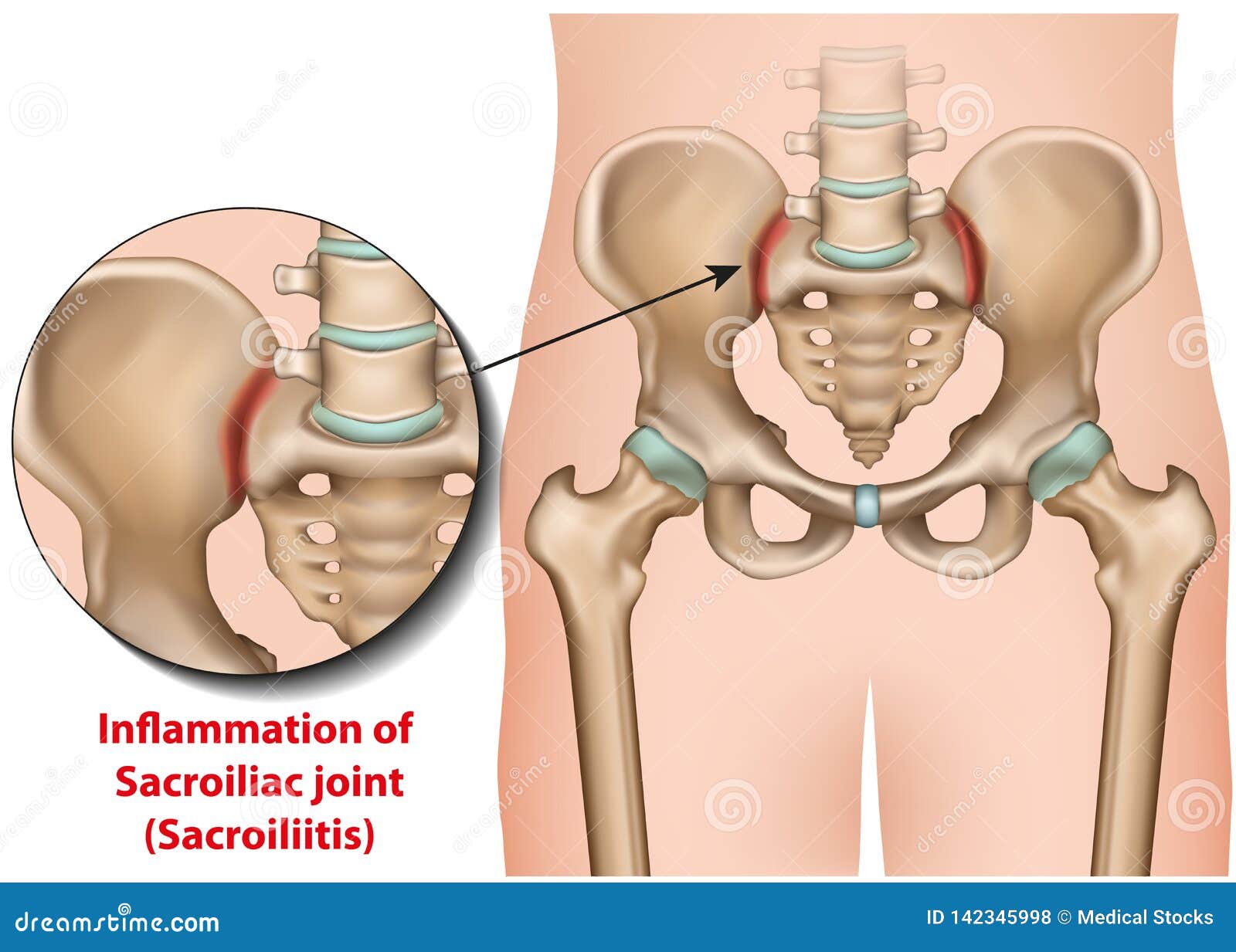 a sacroiliac ízület osteoarthritis kezelése)