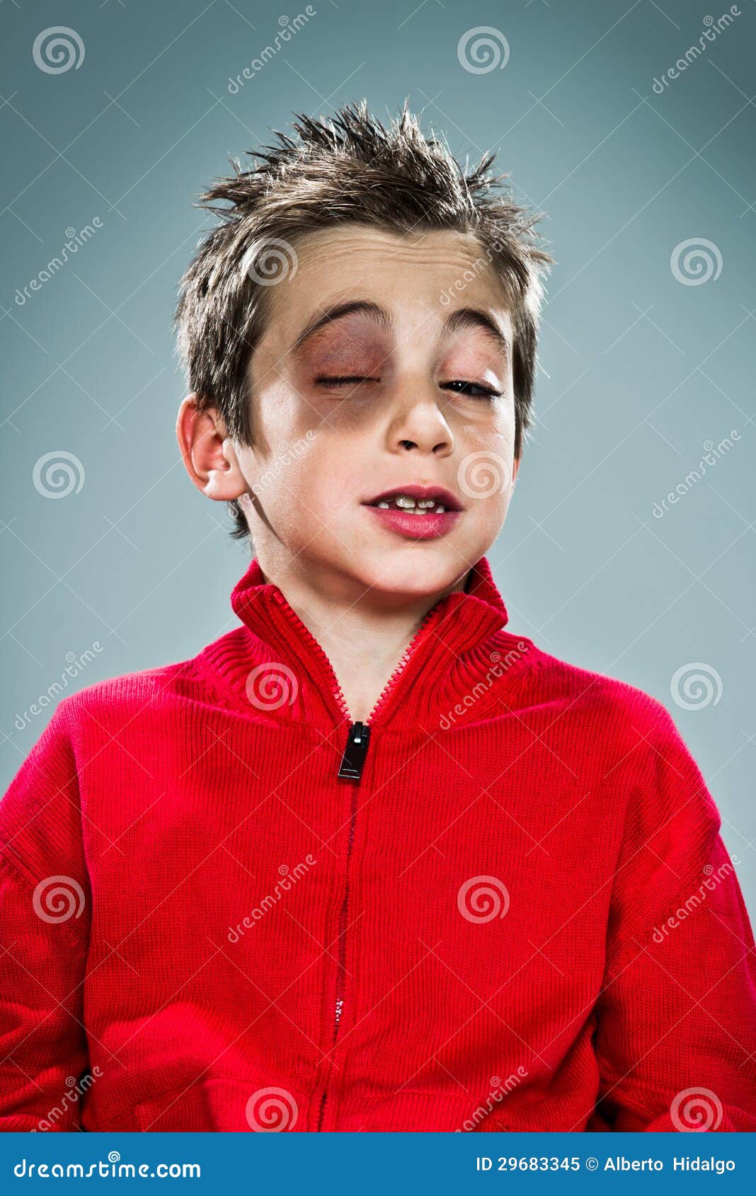 Sad Boy with a Bruise Under One Eye Stock Image Image of casual