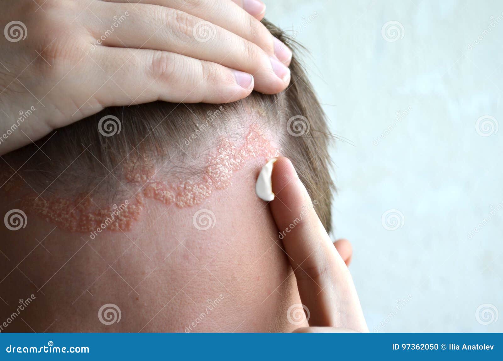 Salben Sie Mit Sahne Salbe Medizinstirn Haarlinie Kopfhaut Mit Psoriasis Dermatitis Problemhaut Ekzem Stockfoto Bild Von Salben Psoriasis