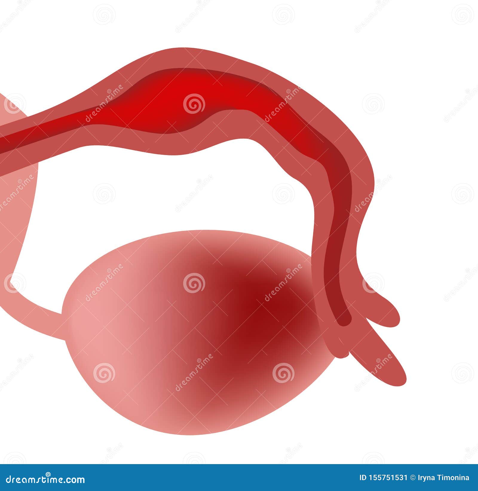 Salpingitis. Inflammation Of The Fallopian Tube. Oophoritis. Inflammation  Of The Ovary. Pelvic Organs. Infographics. Vector Illustration On Isolated  Background. Royalty Free SVG, Cliparts, Vectors, and Stock Illustration.  Image 68281130.