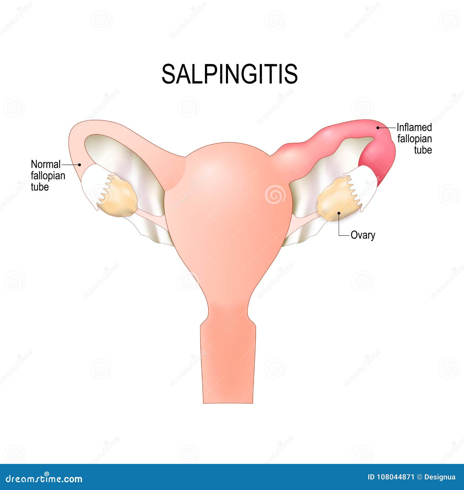 Salpingitis. Inflammation Of The Fallopian Tube. Oophoritis. Inflammation  Of The Ovary. Pelvic Organs. Infographics. Vector Illustration On Isolated  Background. Royalty Free SVG, Cliparts, Vectors, and Stock Illustration.  Image 68281130.