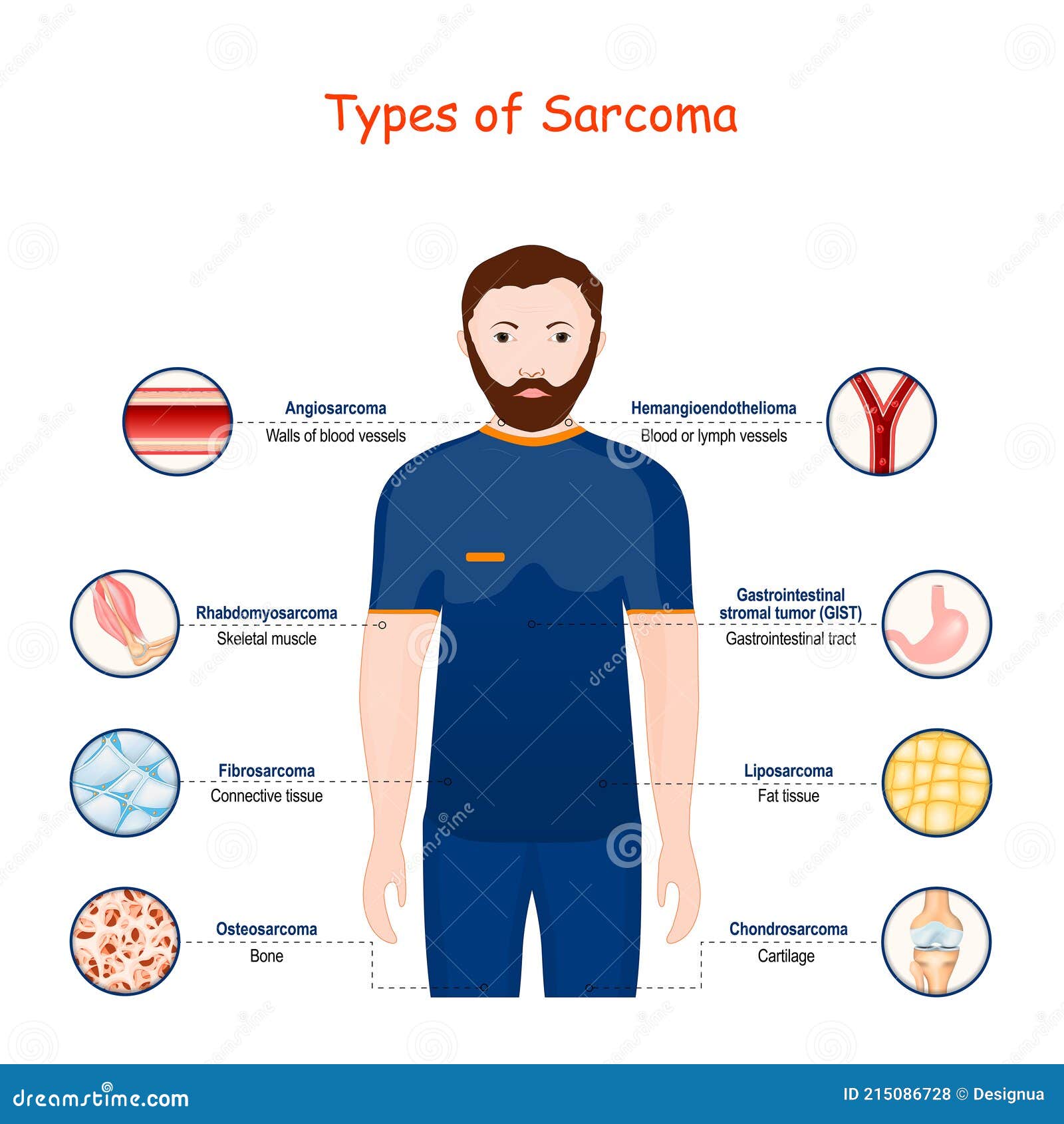 cancer sarcoma tipos
