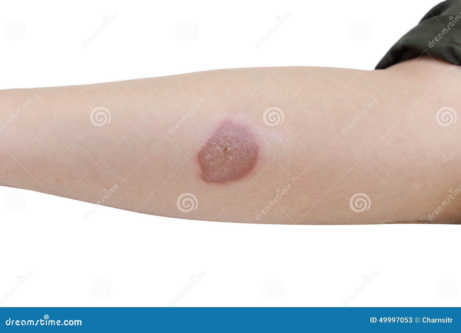 Scald Burn Blister on Forearm Stock Image Image of illness, hospital