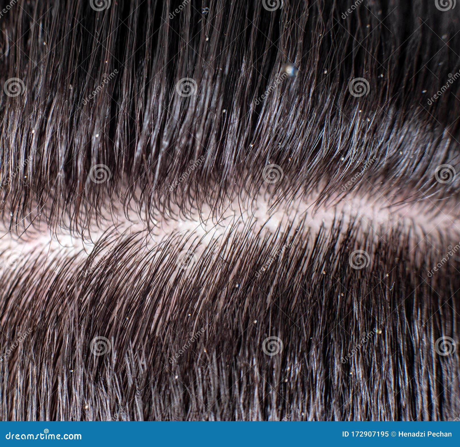 Scales of Dandruff in a Man`s Black Hair. the Concept of Getting Rid of  Dandruff and Hair Care, Background, Macro Stock Image - Image of health,  hair: 172907195