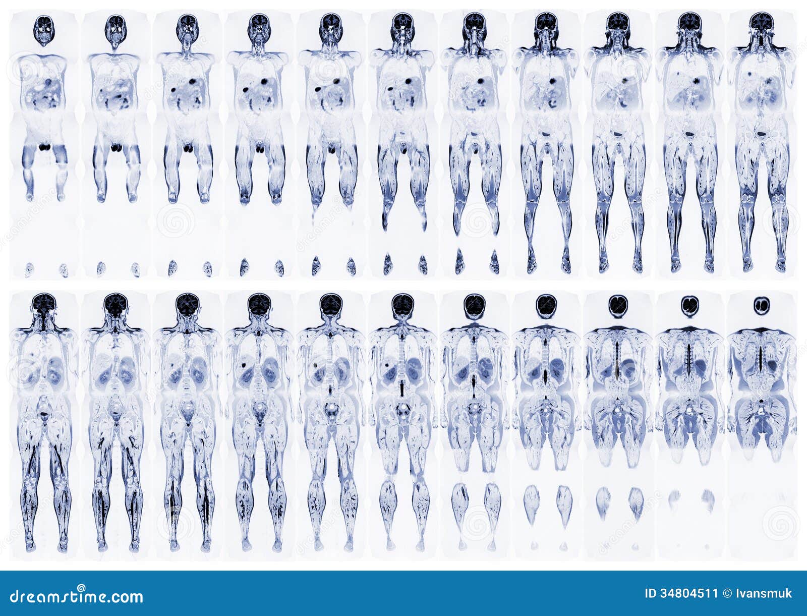 Scan the human body stock image. Image of process, hernia 34804511