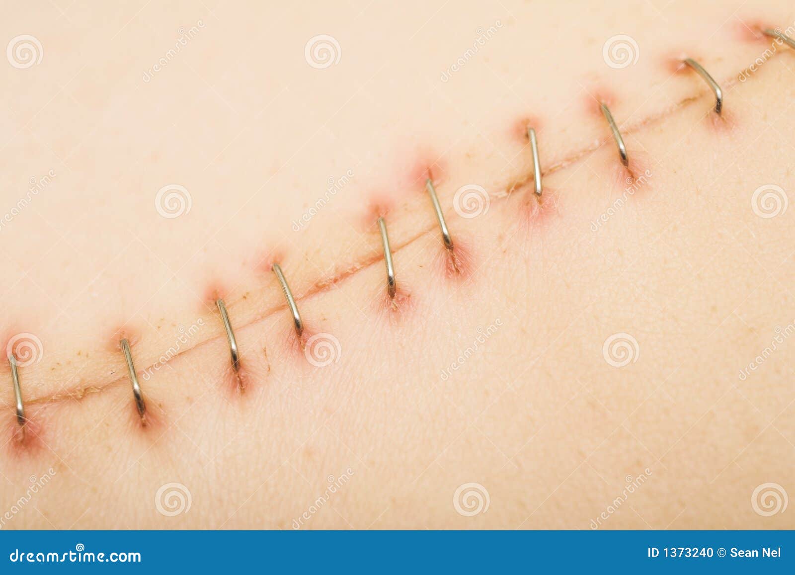 Scar 2 stock photo. Image of metal, steel, recover, heal 1373240