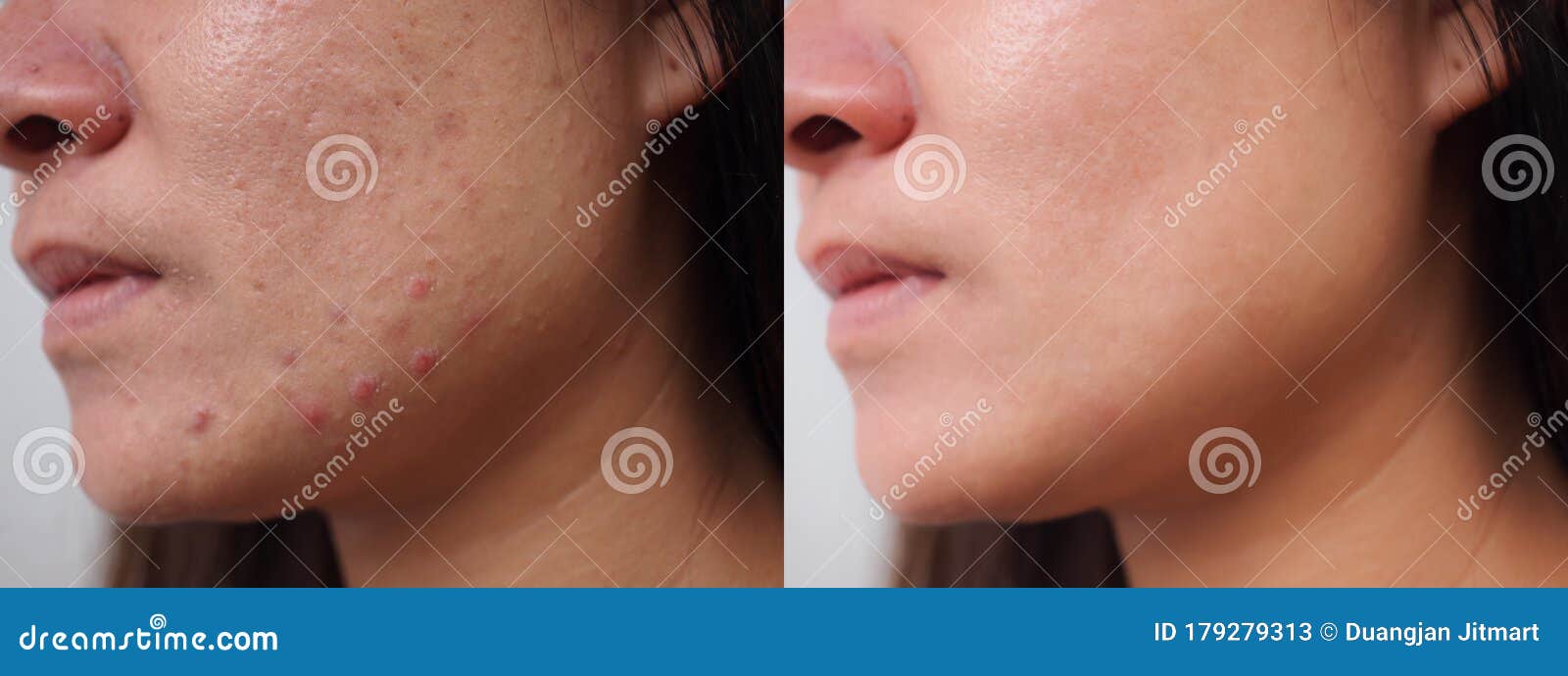 before and after scar acne treatment