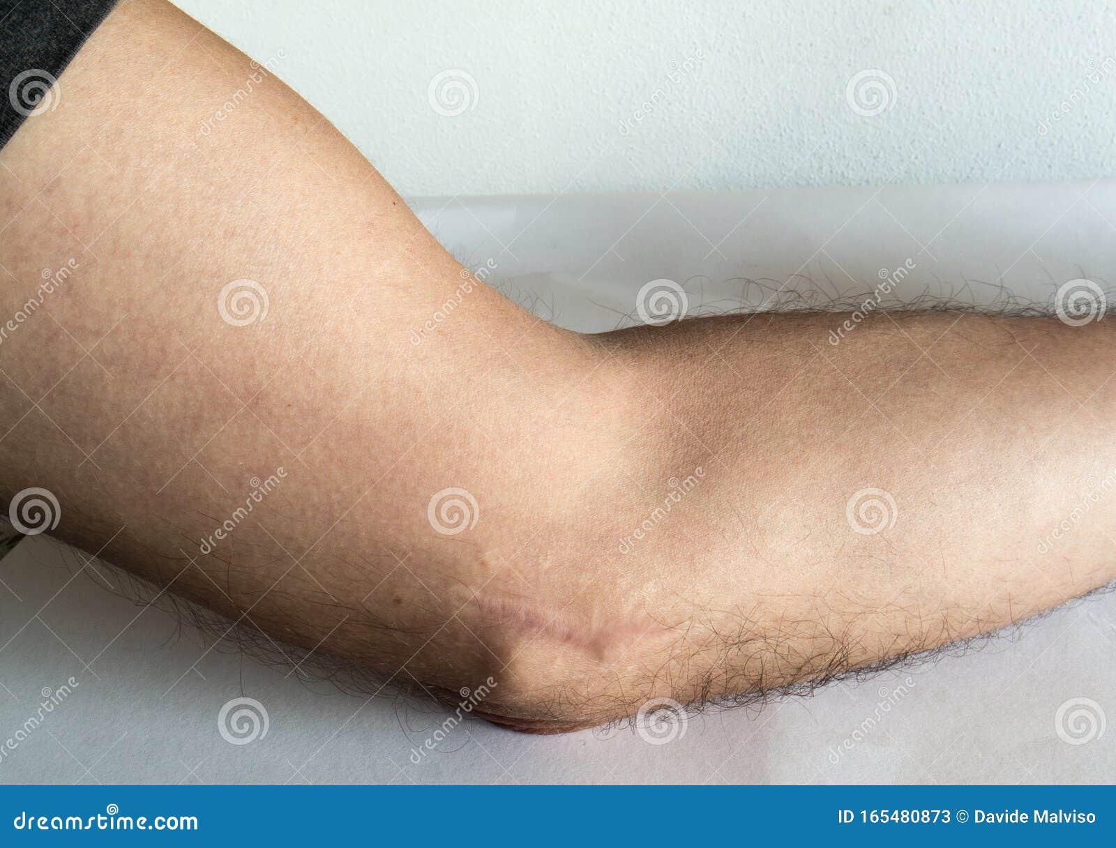 Scar on the elbow stock image. Image of elbow, scar 165480873