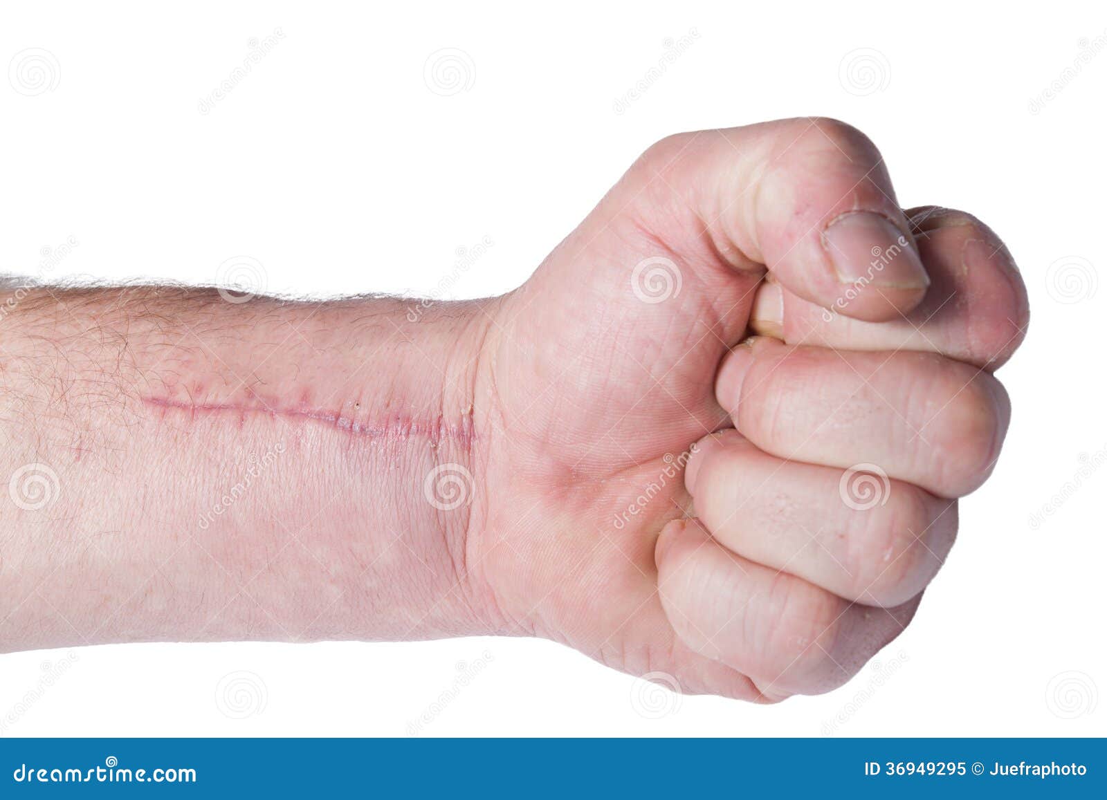 Scar stock image. Image of emergency, scar, injury, handicapped 36949295