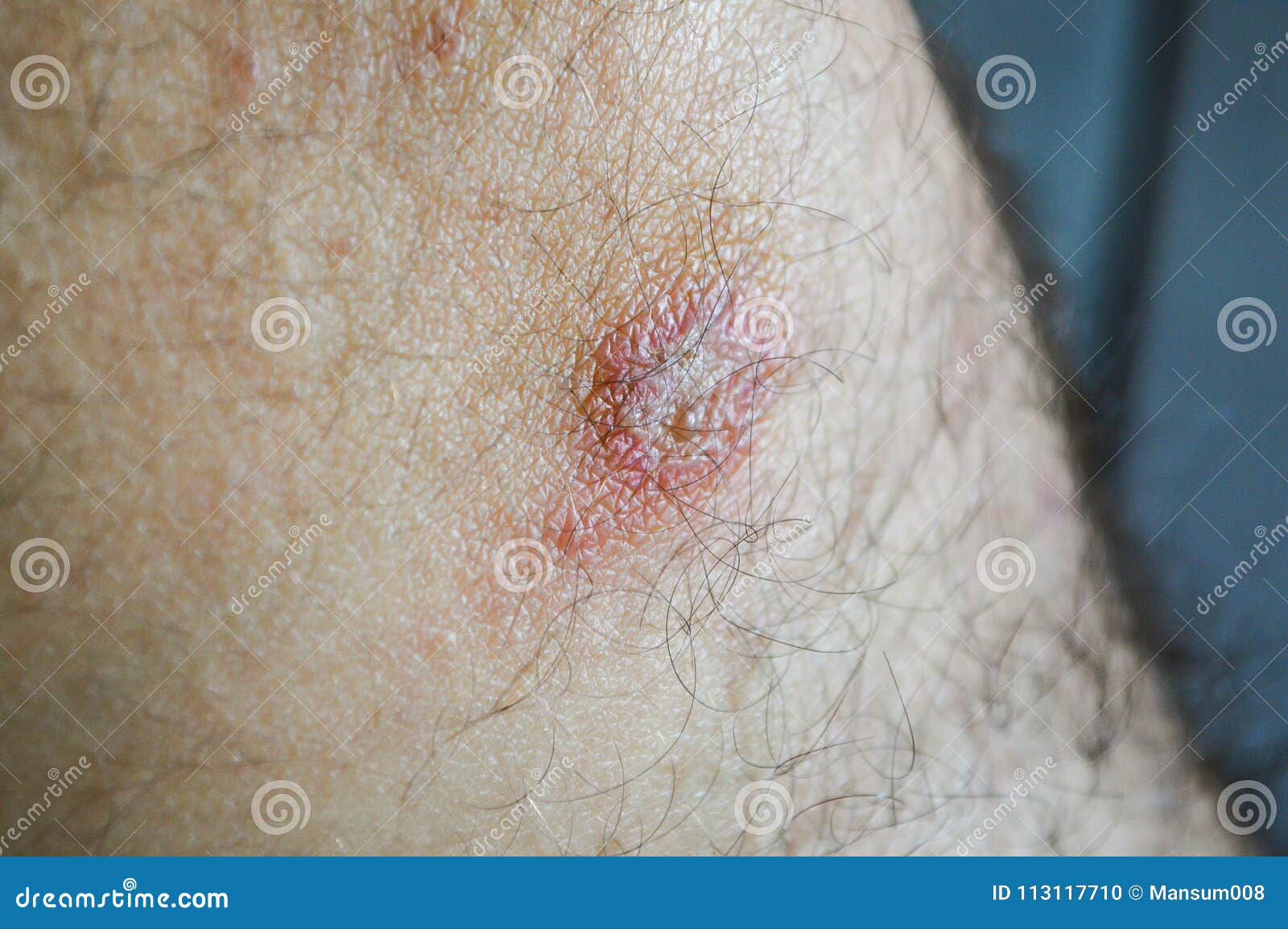 Scar on knee stock photo. Image of sore, illness, lesion 113117710