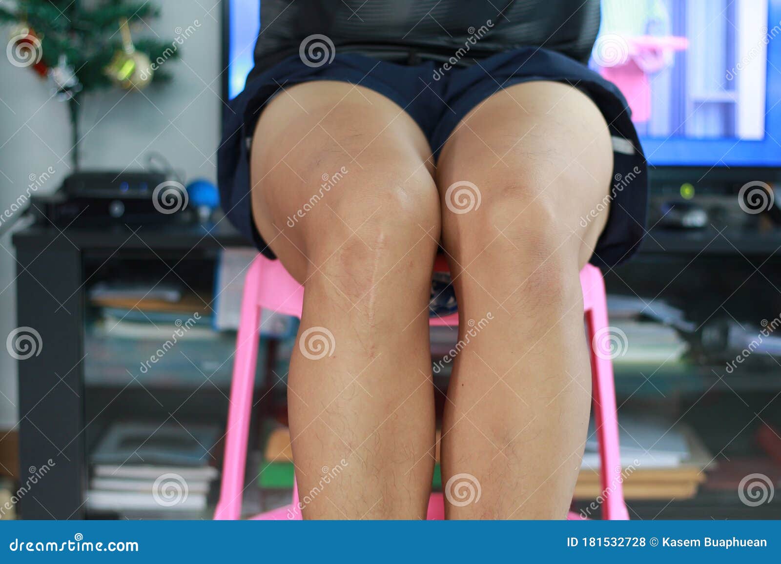 Scar on the Knees, Knee Surgery Stock Photo Image of danger, health