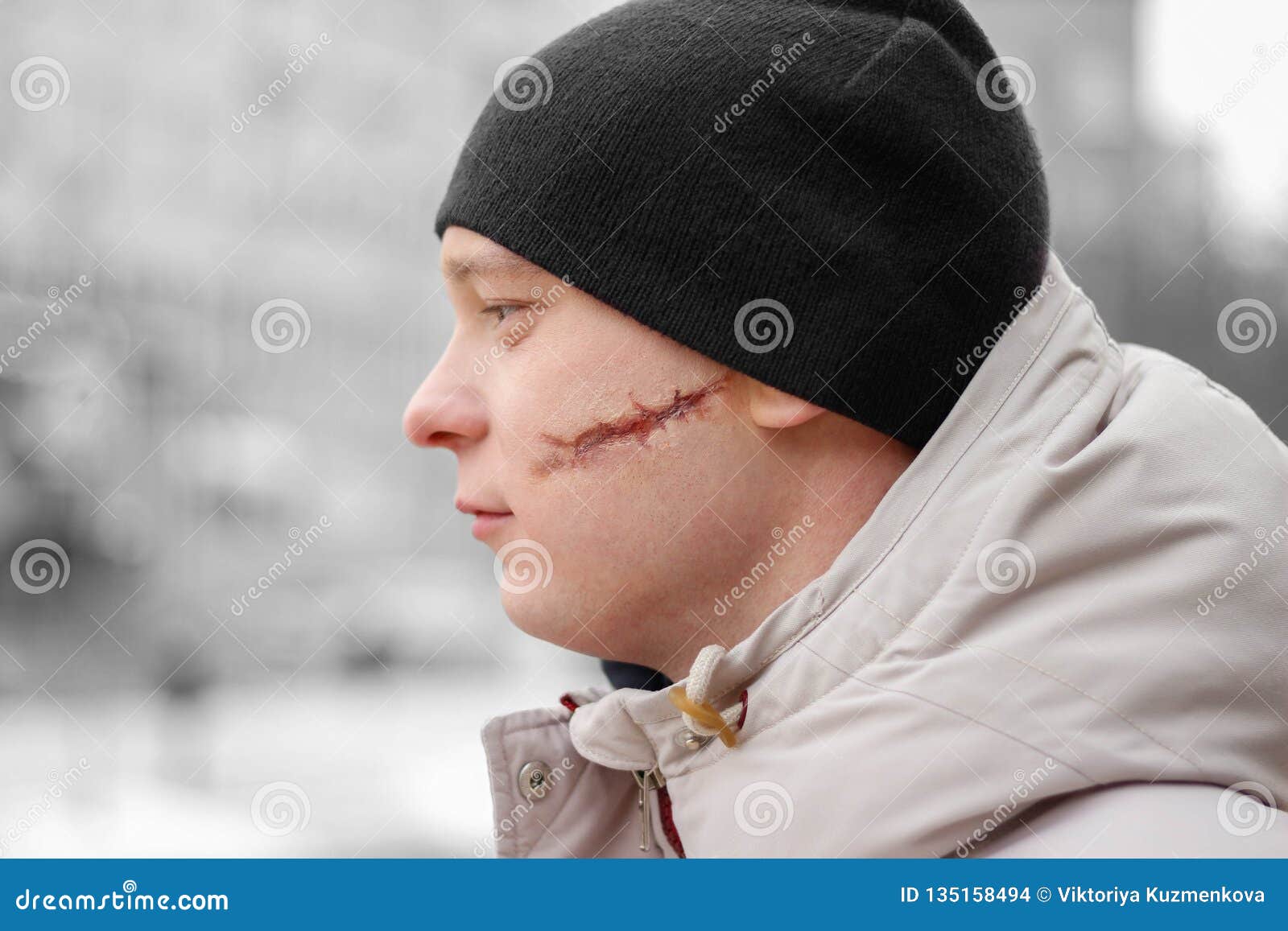 Scarface. a Young Man with a Big Scar on His Face Stock Photo Image