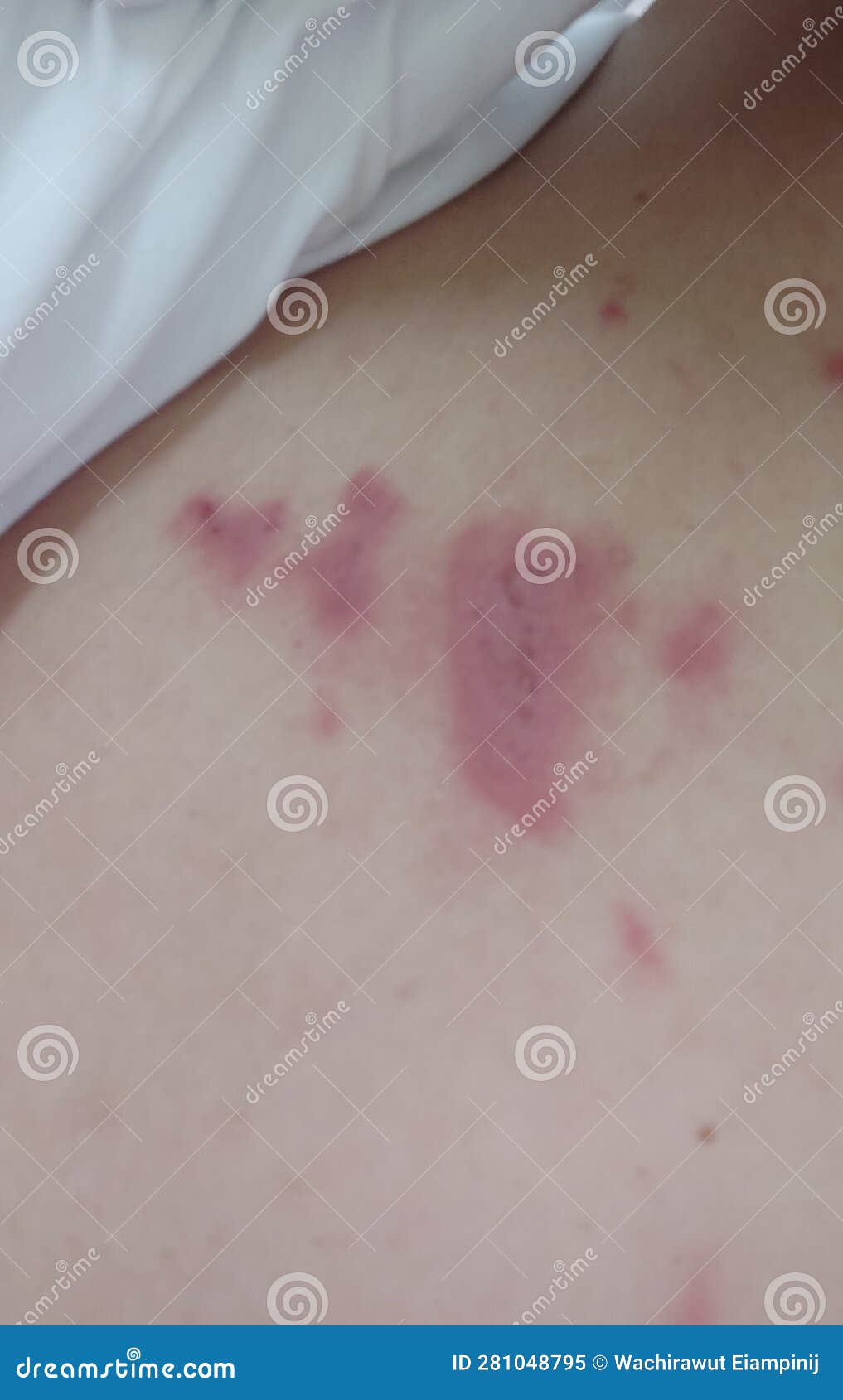 Scars Caused by Insect Venom Stock Image Image of rash, irritation