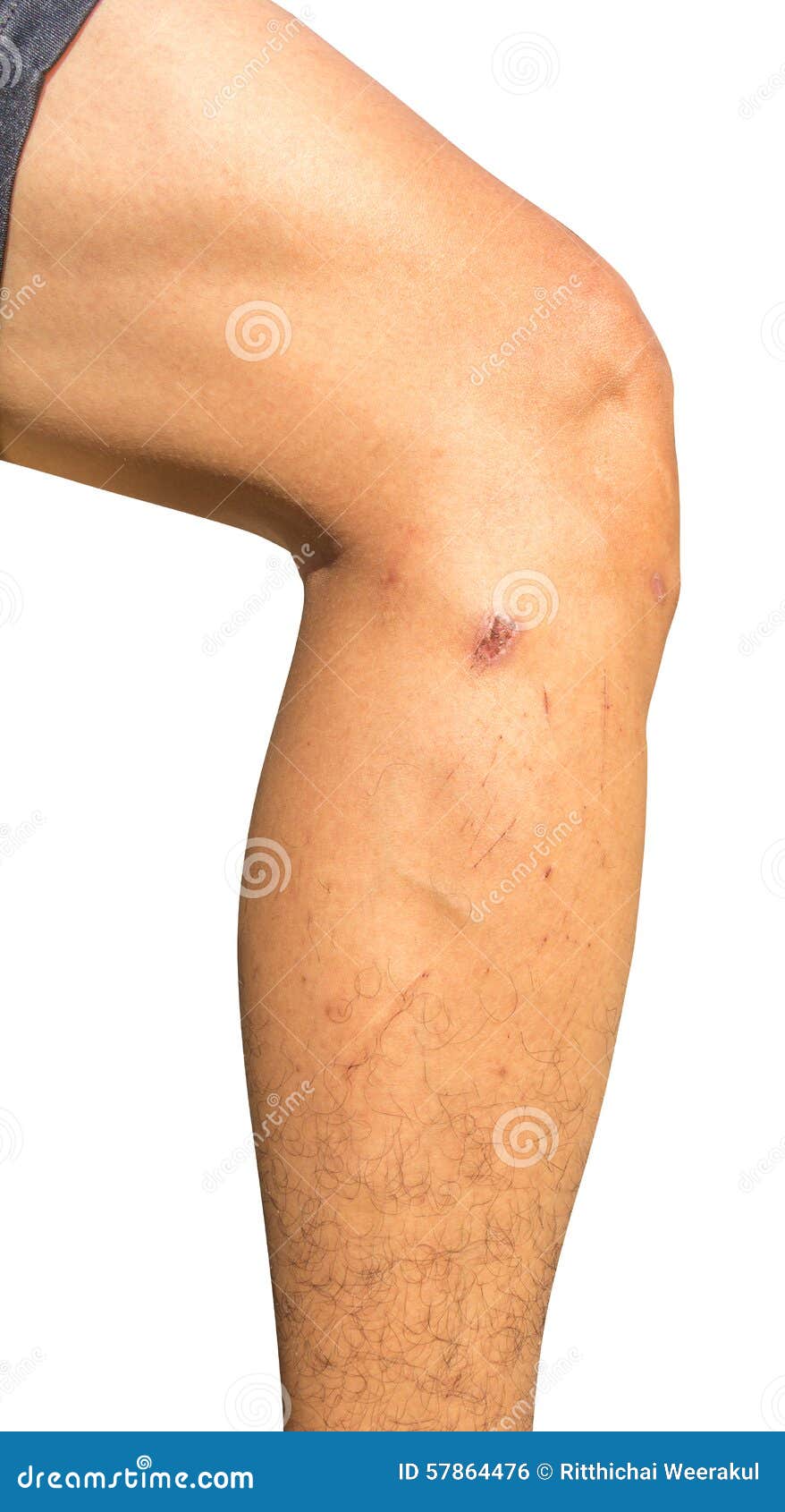 Scars on Leg Isolated on White Background Stock Photo Image of heal