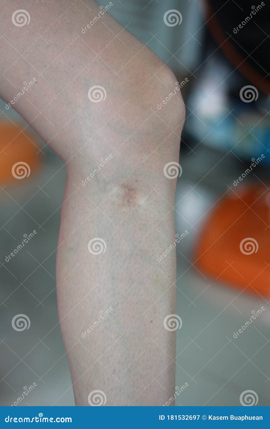 Scars on the Skin Around the Legs, Scar on a Girl`s Leg Close-up. Varicose  Veins from the Injury on the Leg Stock Image - Image of isolated, hospital:  181532697