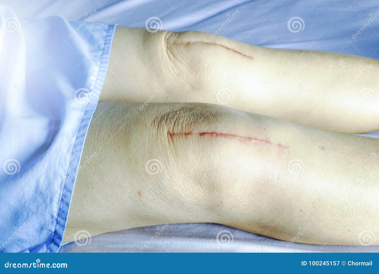 Scars Surgical Knee Surgery Stock Image Image of replacement, illness 100245157