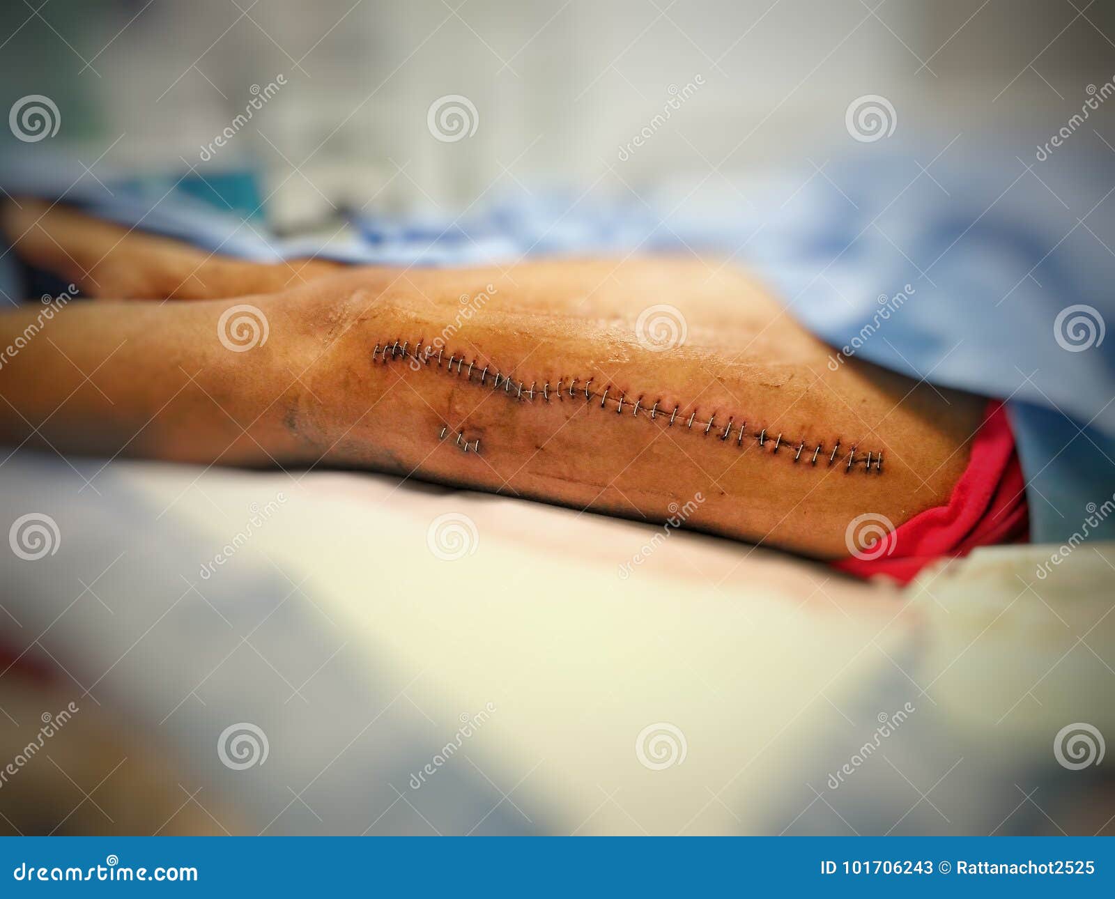 Scars wound stock image. Image of scars, staple, left 101706243