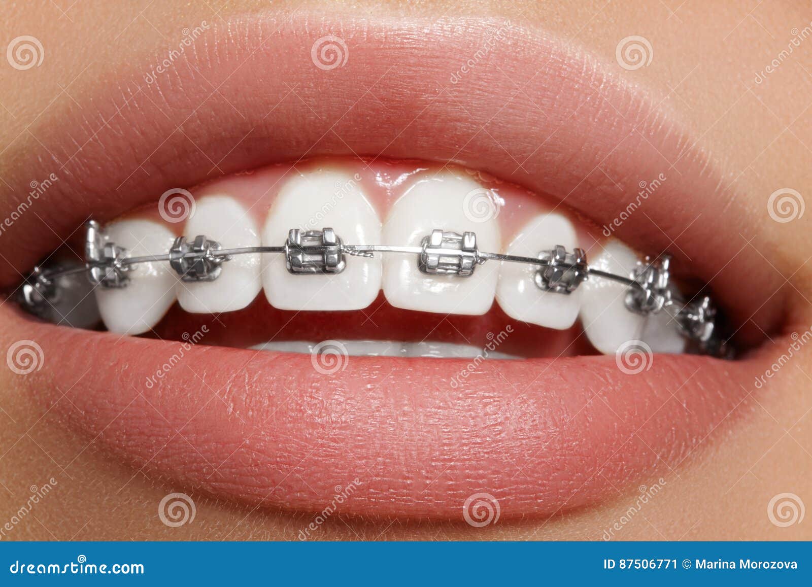 Schone Weisse Zahne Mit Klammern Zahnpflegefoto Frauenlacheln Mit Ortodontic Zubehor Orthodontiebehandlung Stockbild Bild Von Schone Klammern