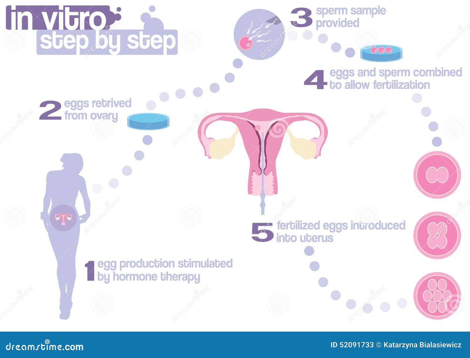 scheme of in vitro fertilization