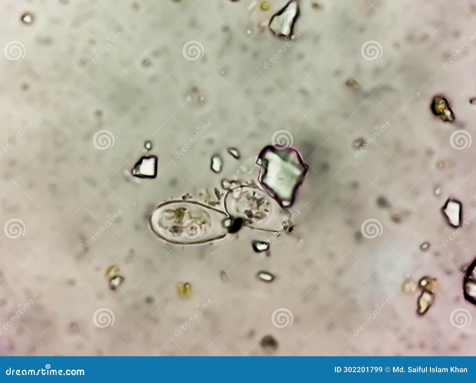 Schistosoma Parasite Ova in Human Urine Specimen Under Microscope Stock