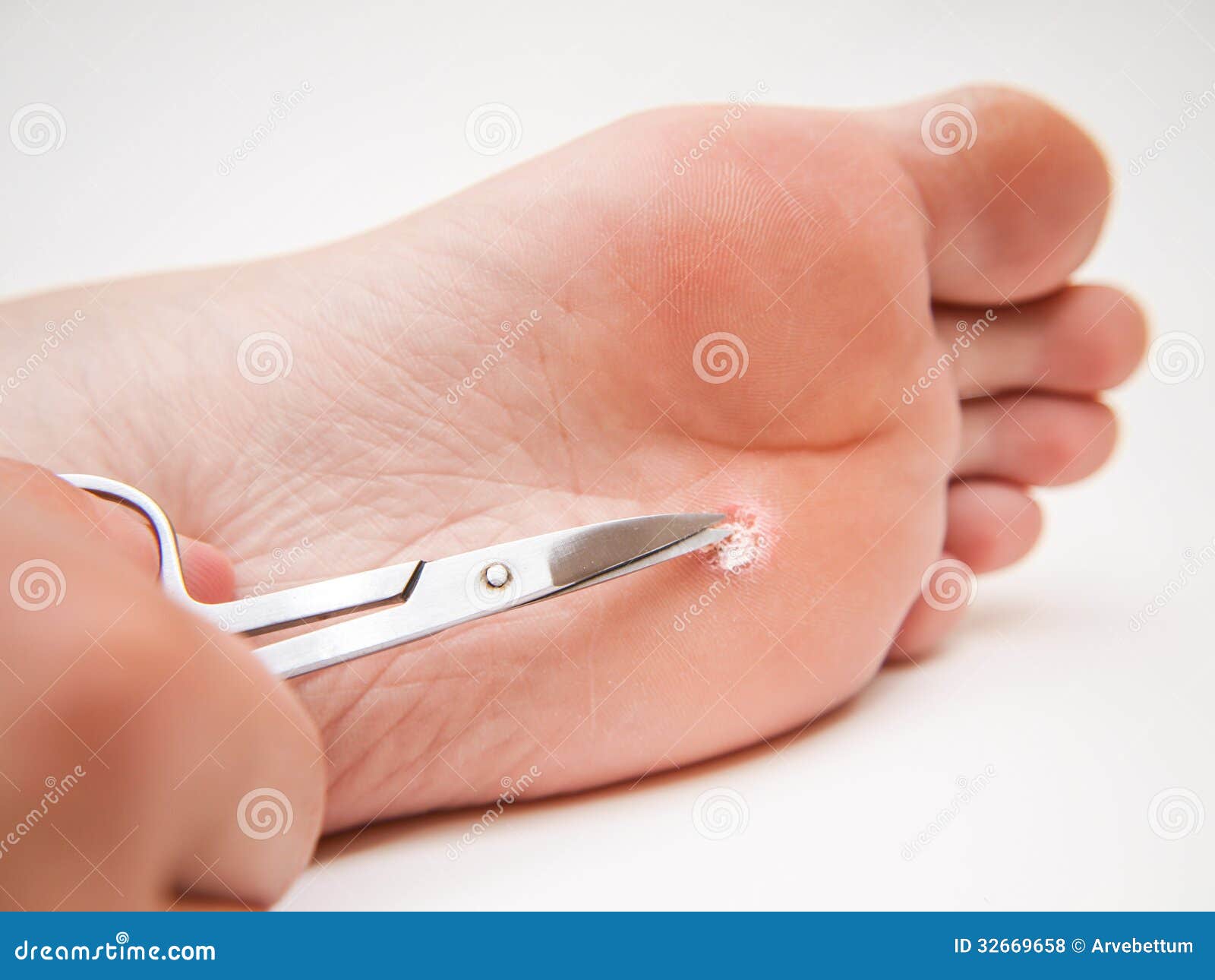 Schwiele unter Fuß stockfoto. Bild von sonderkommando 32669658