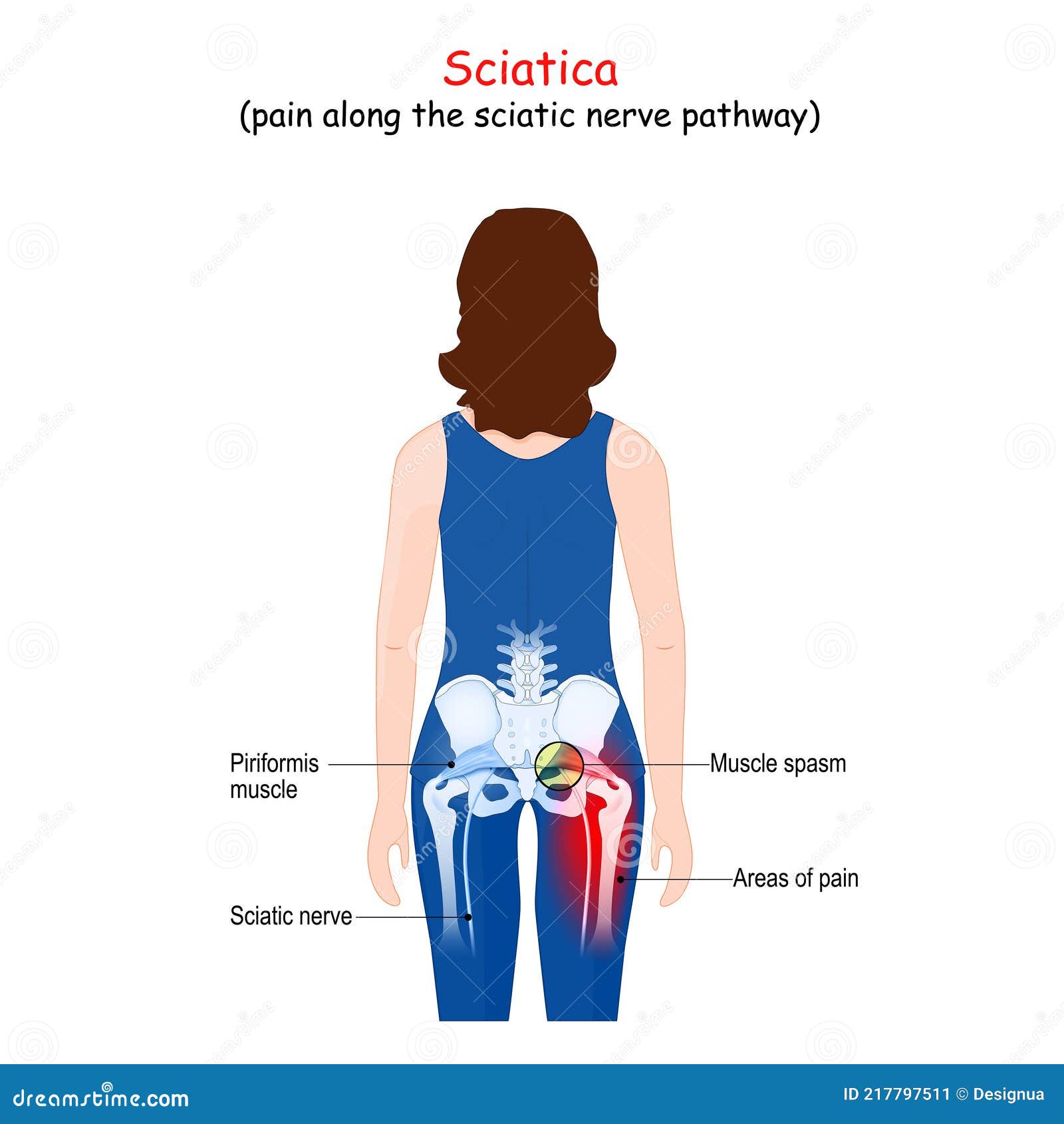 sciatica.  body of a patient woman with areas of pain from the back. piriformis