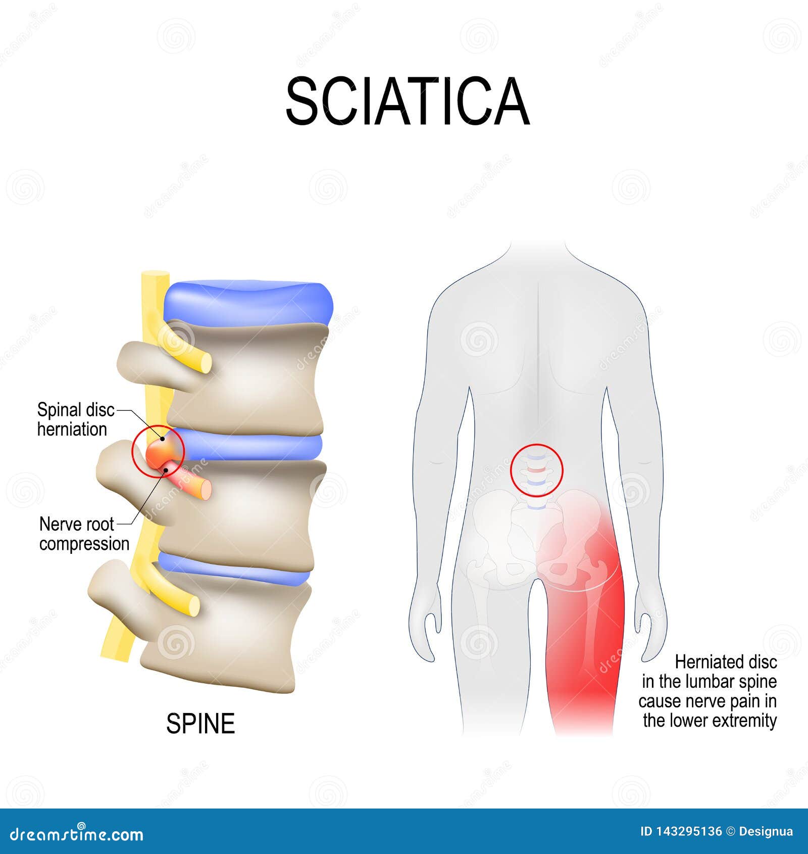 Sciatica Schema Con Le Vertebre I Dischi Ed I Nervi Corpo Umano Dalla Parte Posteriore Illustrazione Vettoriale Illustrazione Di Disco Corpo