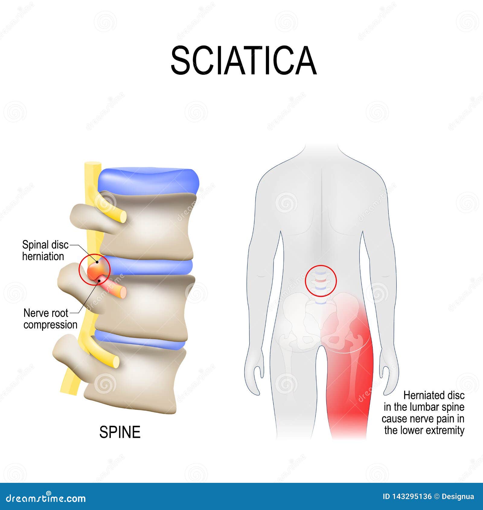 sciatica. scheme with vertebrae, disks and nerves. human body from back