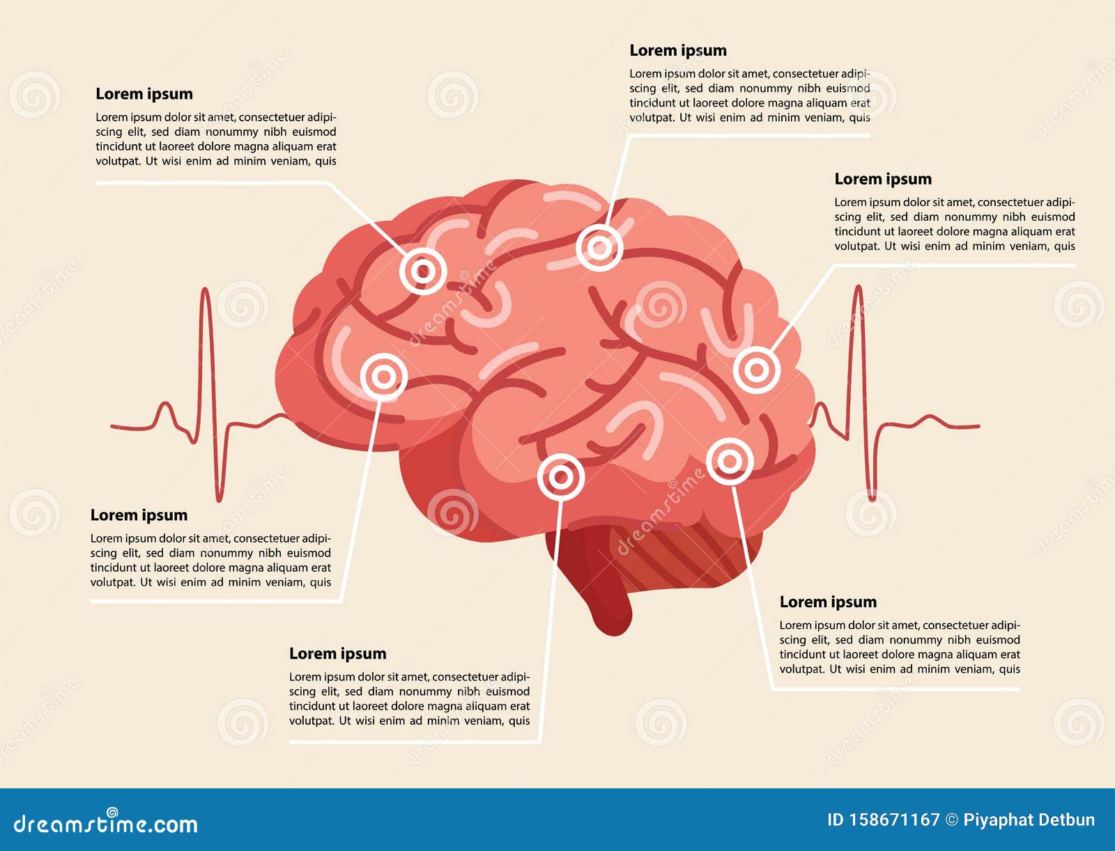 Stroke Types Set. Hemorrhagic And Ischemic Brain Stroke. Damaged Human ...