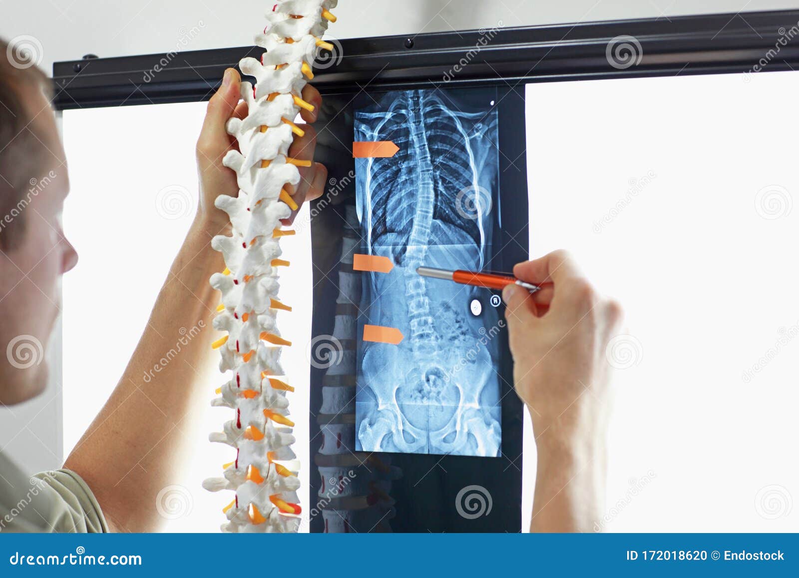 scoliosis.diagnosis,treatment planning. doctor with model of spine watching image of chest at x-ray film viewer.