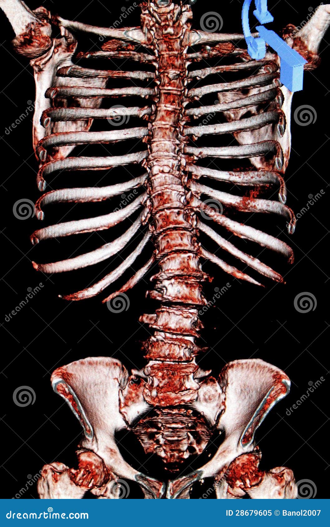 scoliosis. osteoporosis. ct-scan reconstruction