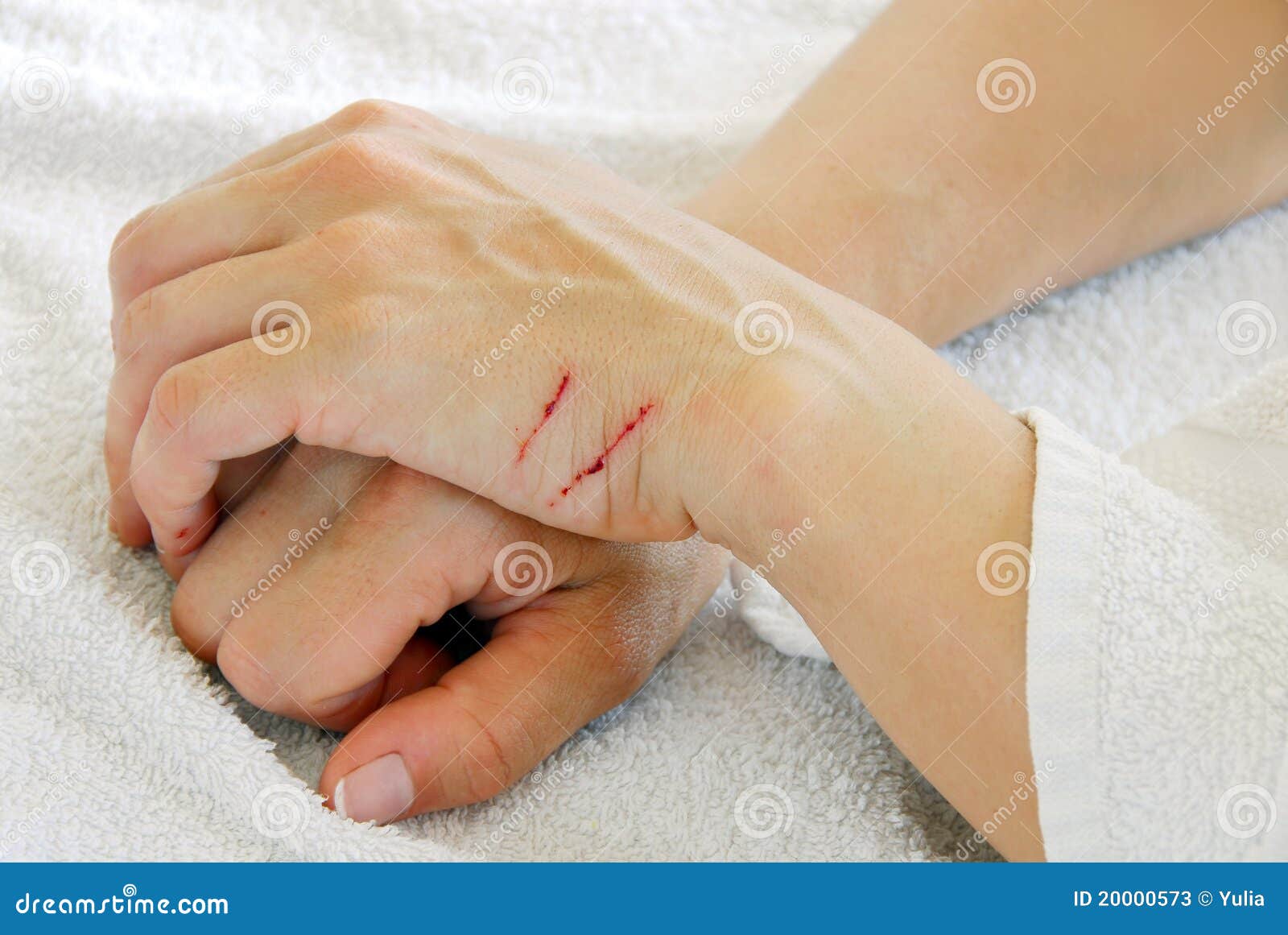 Scratched arms stock image. Image of hurt, body, scrape - 20000573