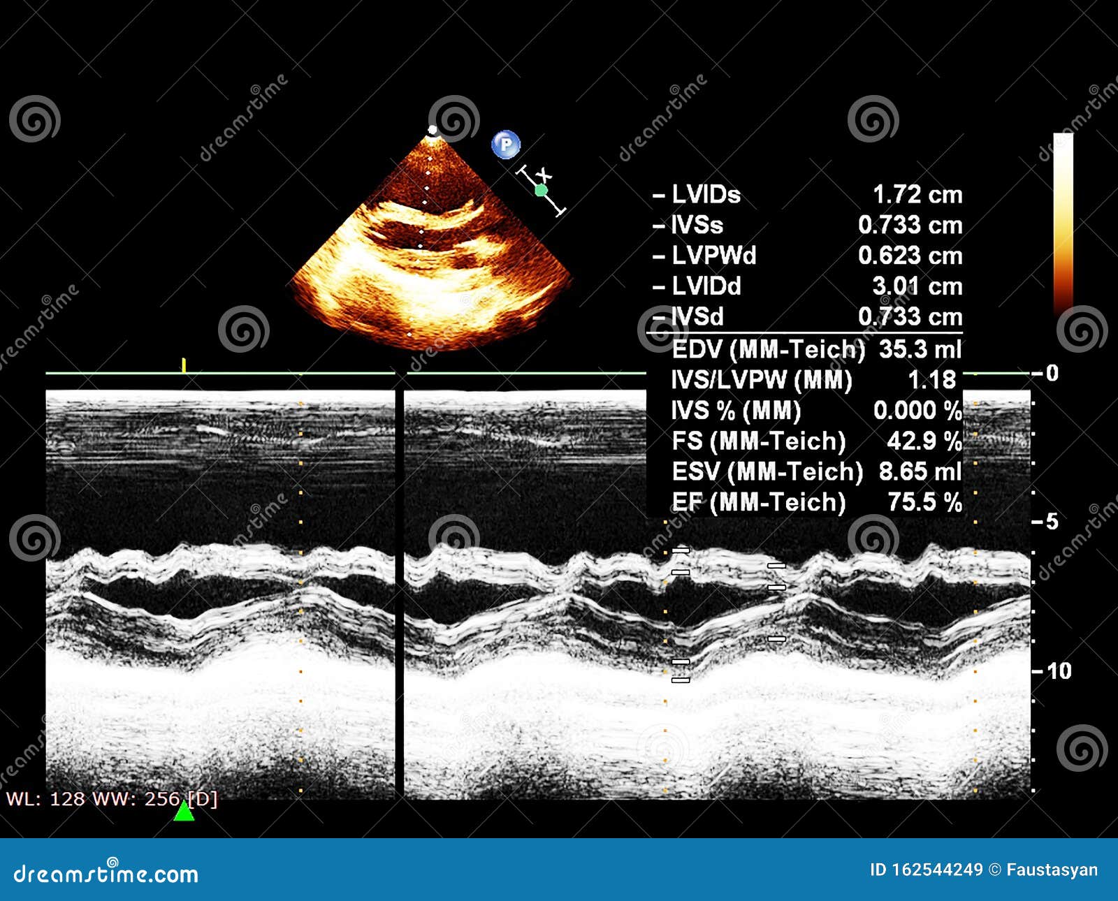 Screen of Echocardiography Ultrasound Machine Stock Image - Image of