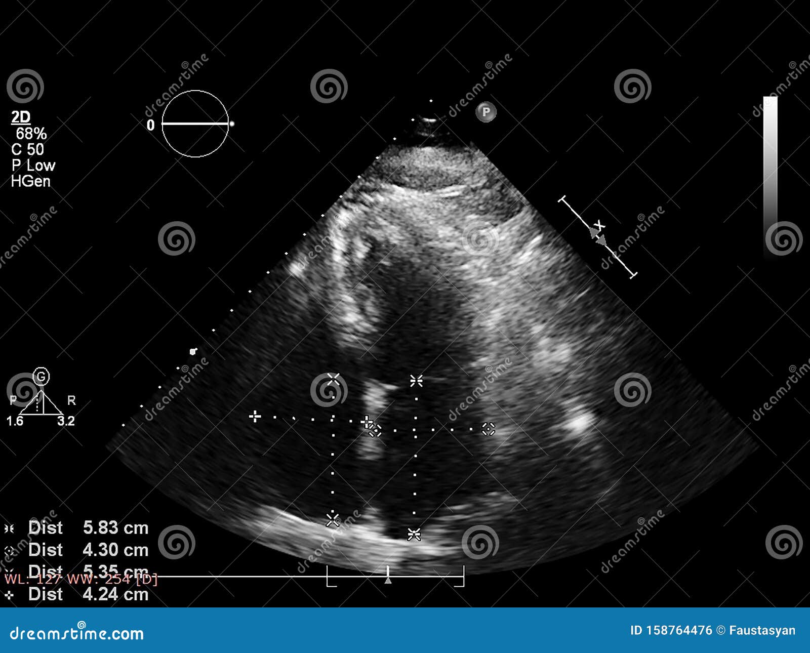 Screen of Echocardiography Ultrasound Machine Stock Photo - Image of