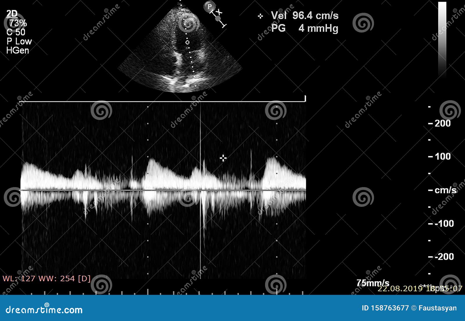 Screen of Echocardiography Ultrasound Machine Stock Image - Image of