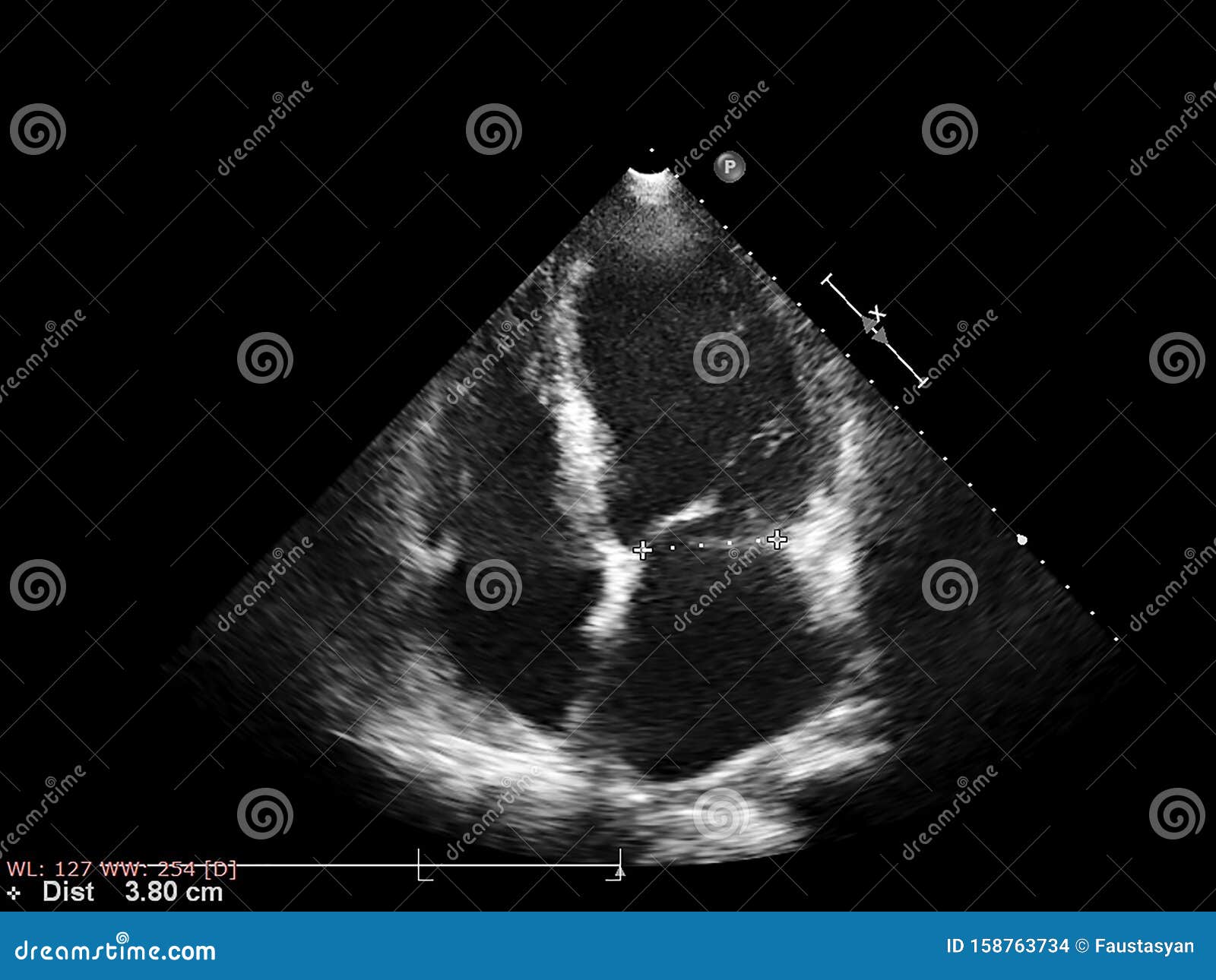 Screen of Echocardiography Ultrasound Machine Stock Photo - Image of