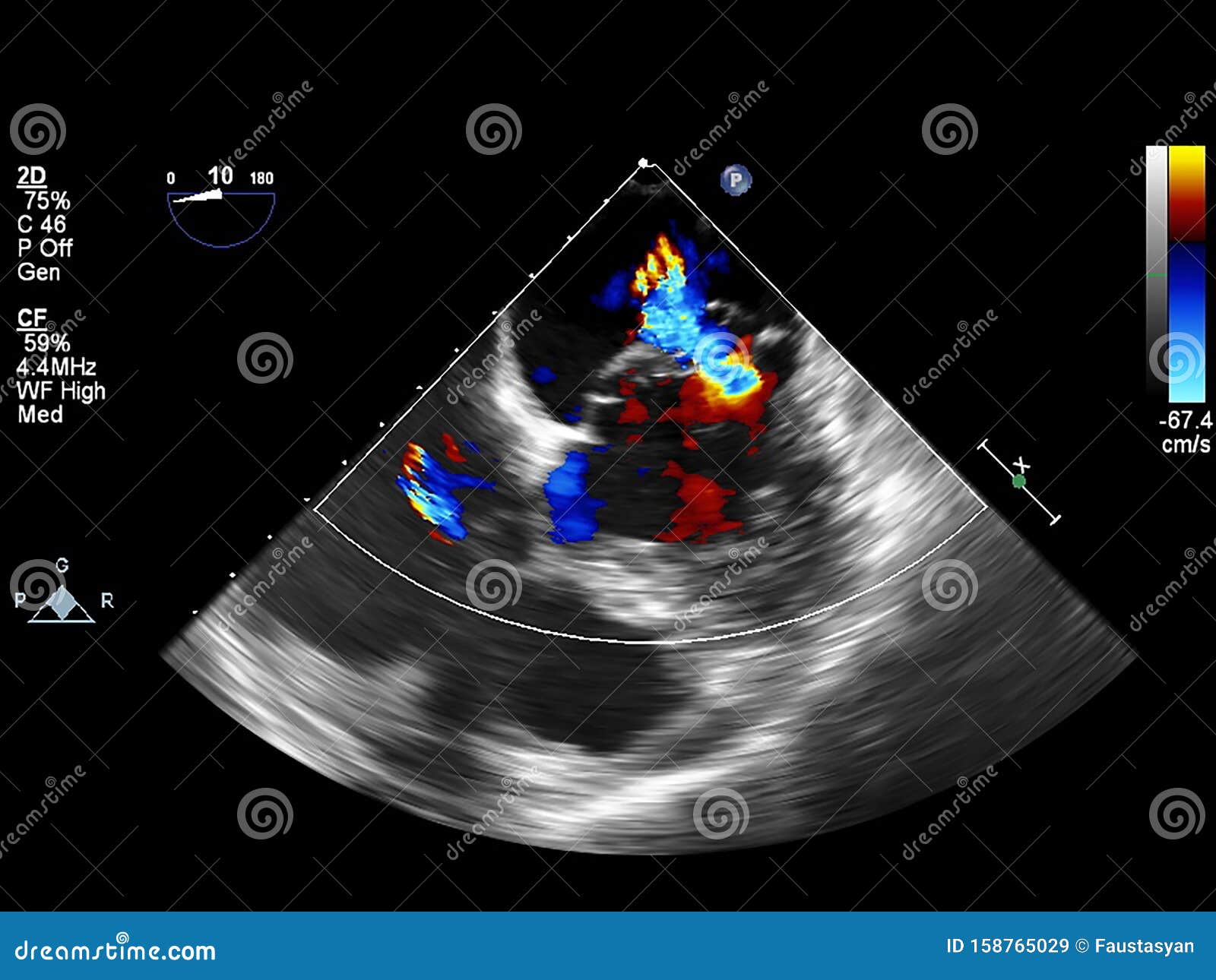 Screen of Echocardiography Ultrasound Machine Stock Image - Image of