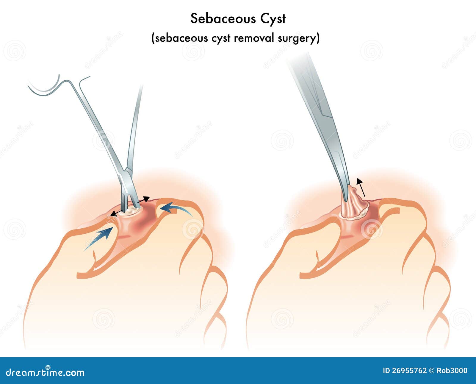 Sebaceous Cyst On Scalp