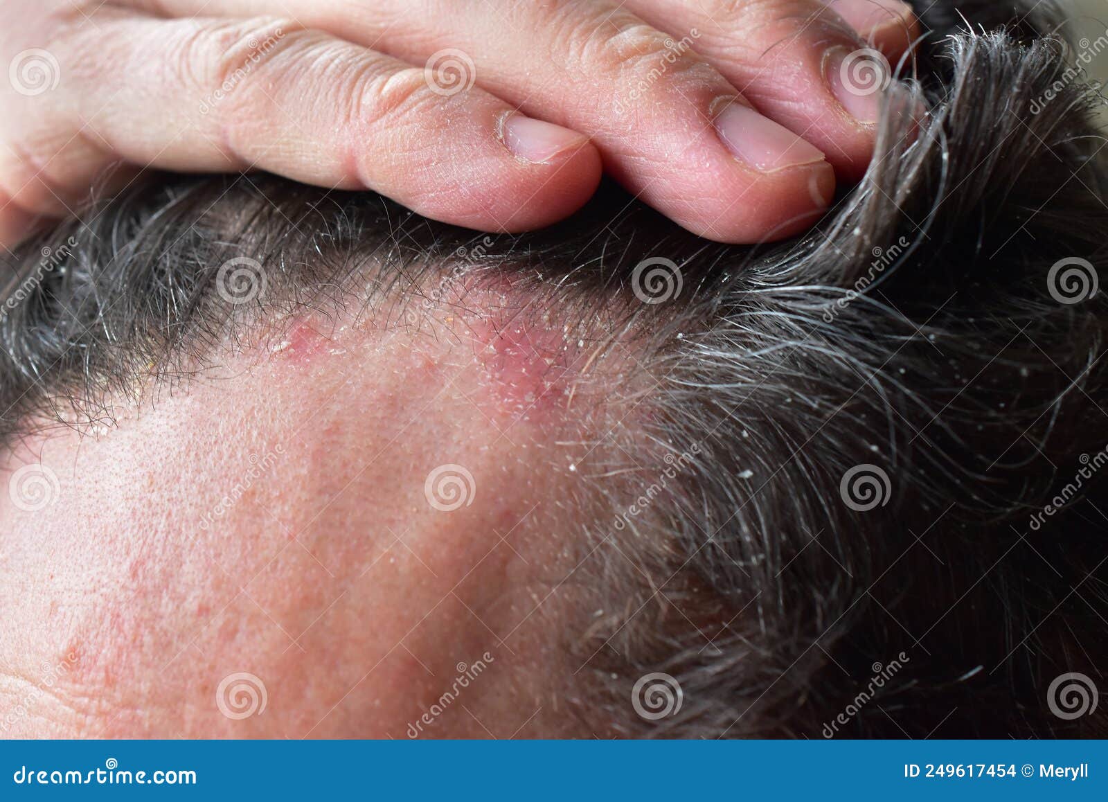 seborrhea dermatitis hair dandruff