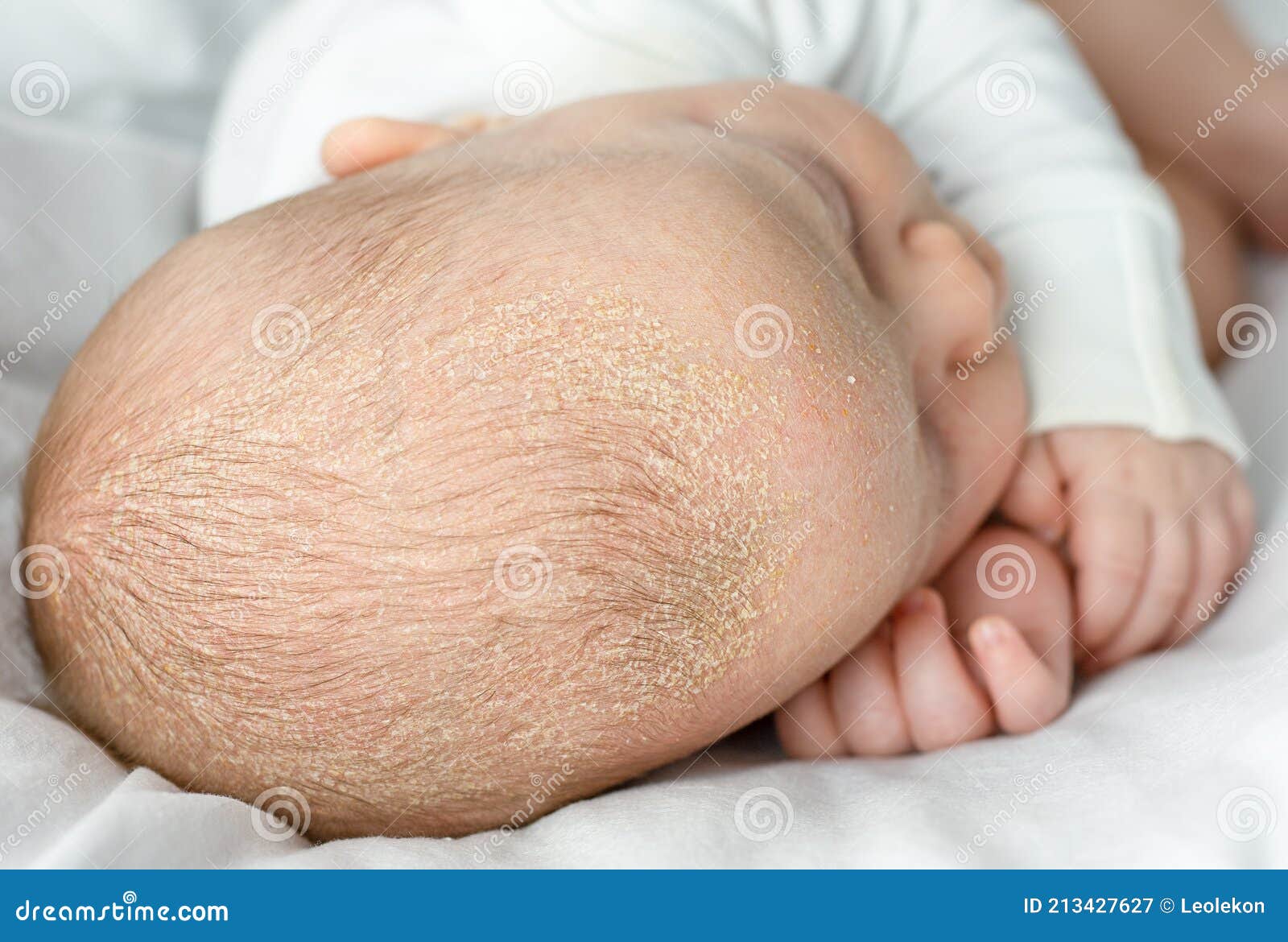 seborrheic dermatitis crusts on the baby`s head. child with seborrhea in the hair
