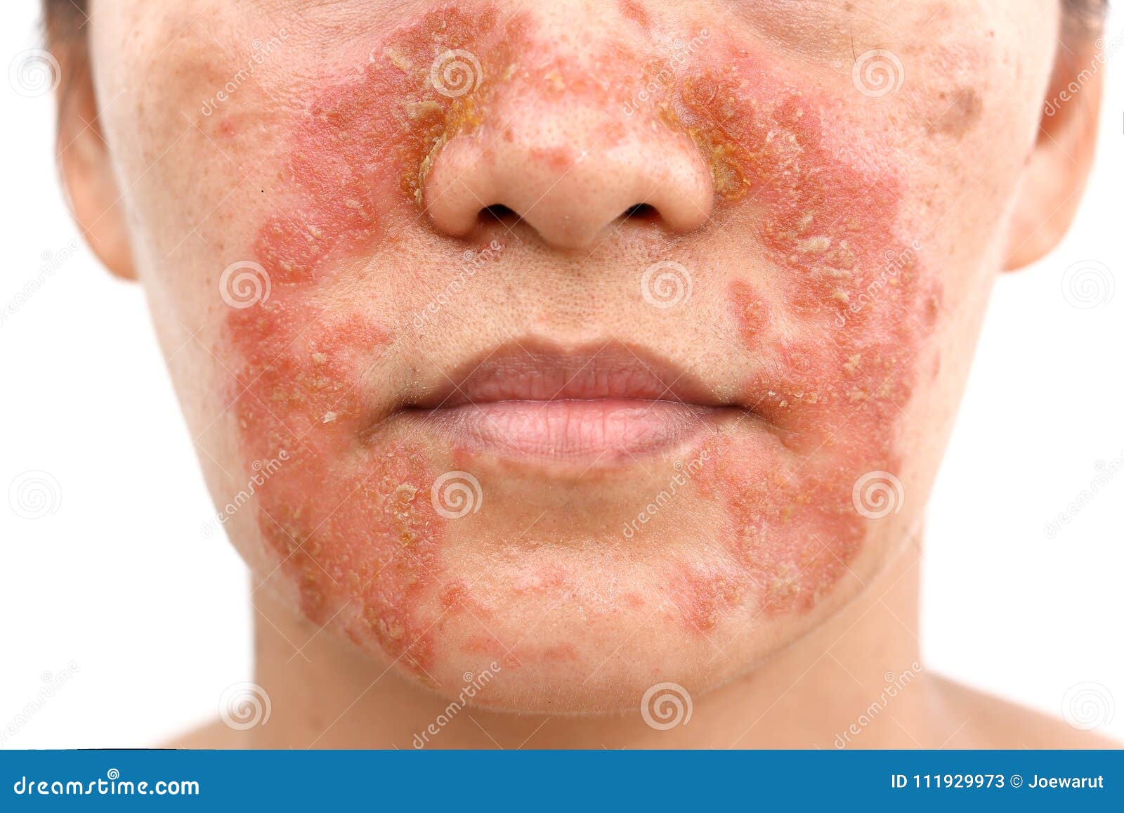 seborrheic dermatitis on face