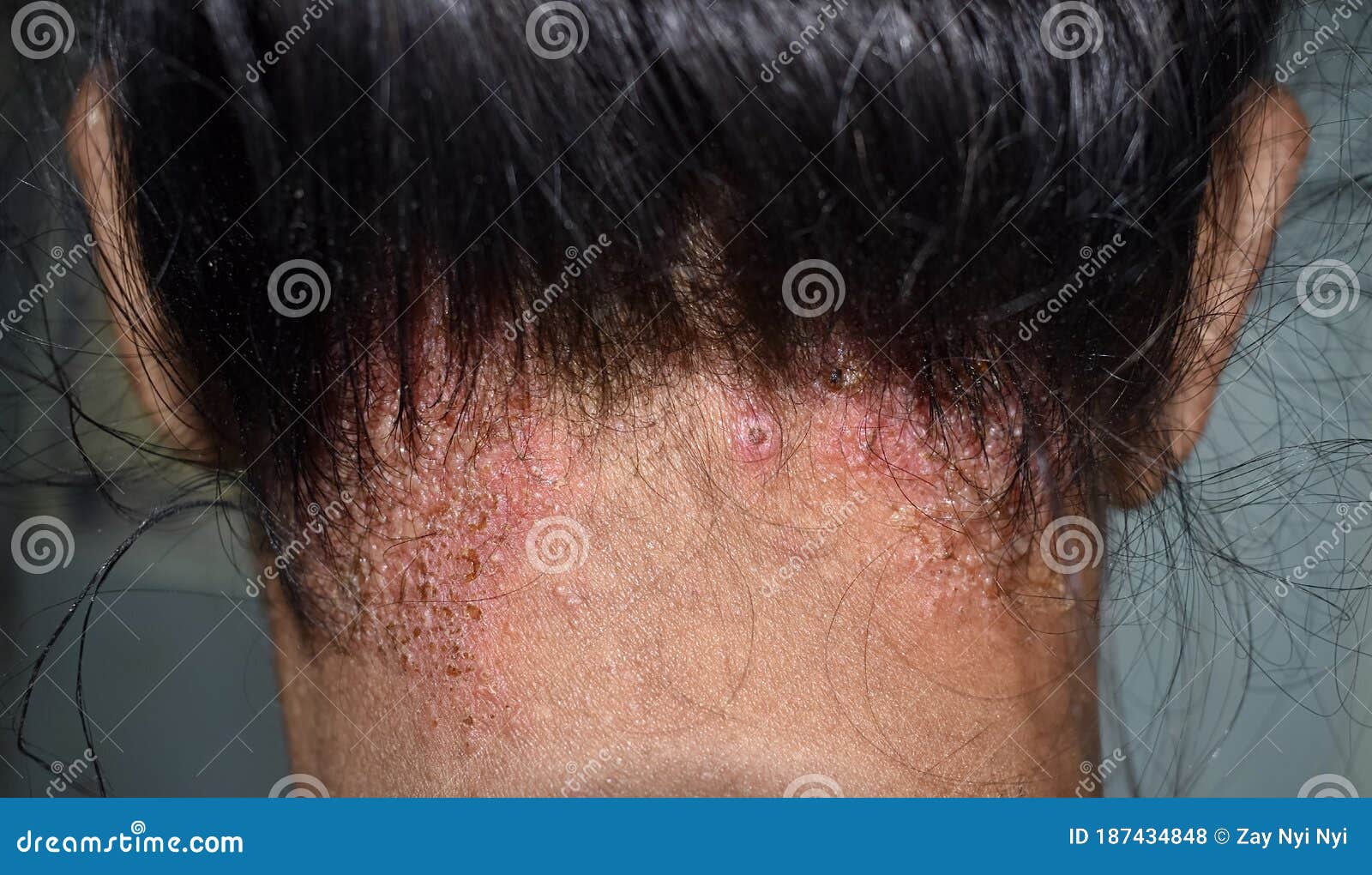 Seborrheic Dermatitis or Fungal Skin Infection at the Scalp of Southeast  Asian, Myanmar Adult Female Patient Stock Photo - Image of dermatophytosis,  adult: 187434848