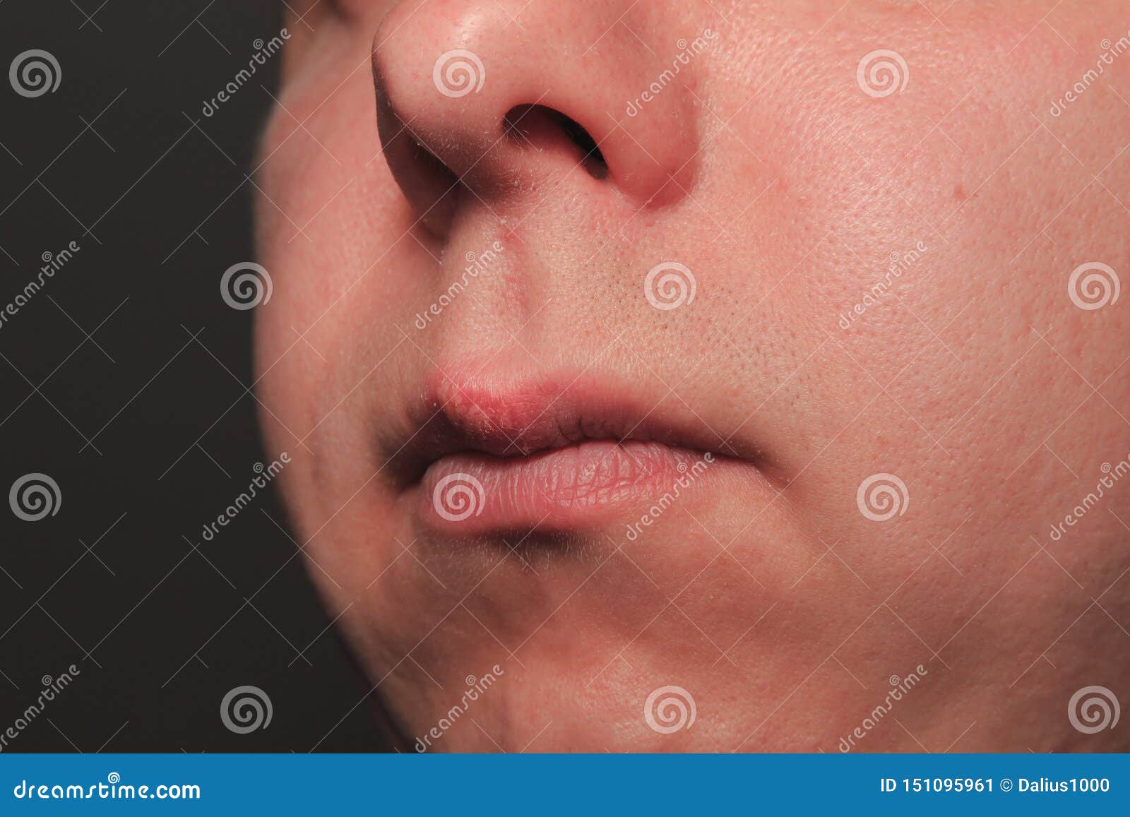 Second Day of Growing Herpes on Caucasian Male Man on Front Upper Lip