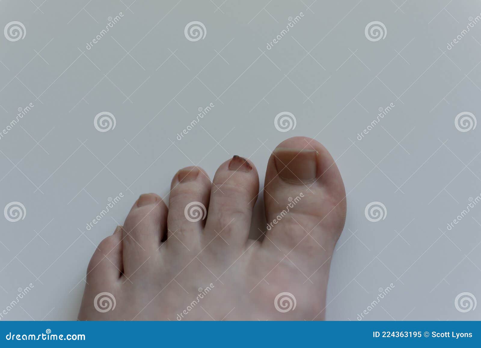 Second Toe Nail Bloody and Bruised on White Stock Image Image of