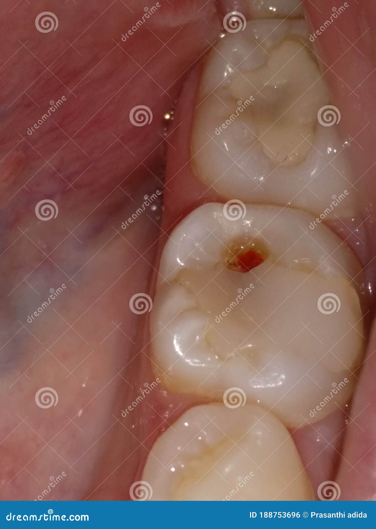 secondary caries