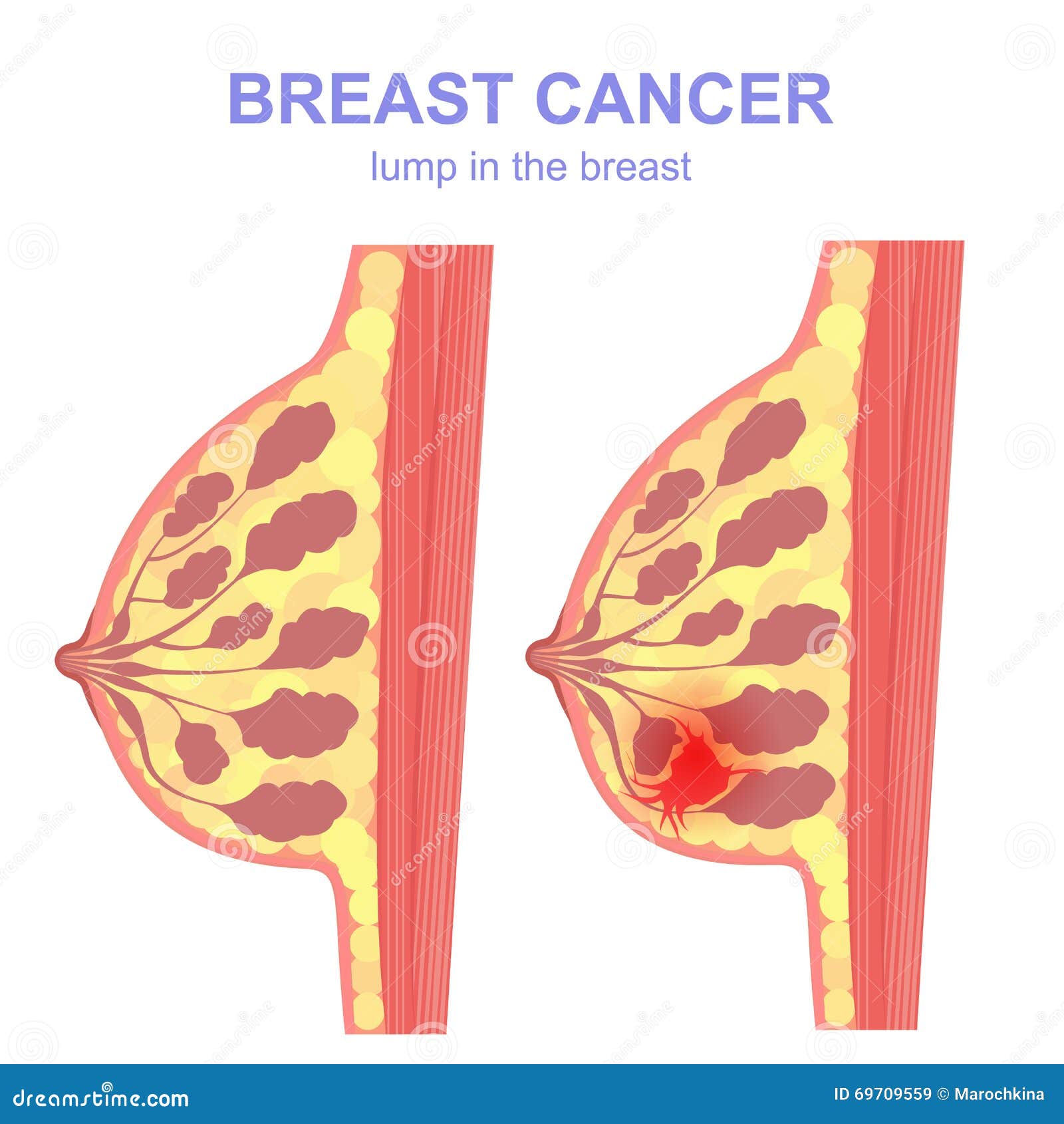 Breast Cancer. Cross-section of the Mammary Gland with Tumor Stock