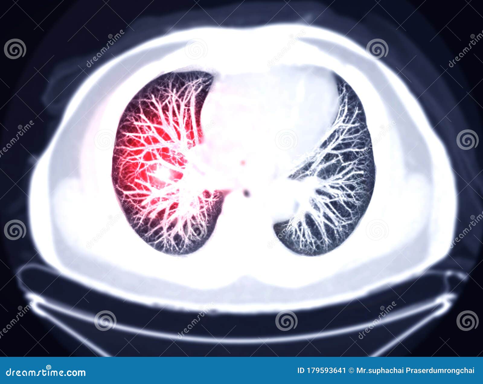 selective focus of ct chest axial mip view for diagnostic pulmonary embolism pe.