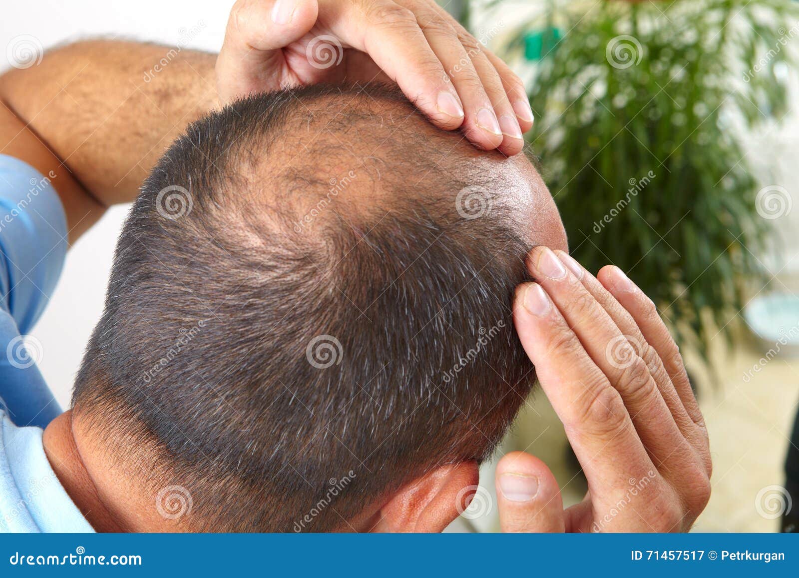 senior man and hair loss issue
